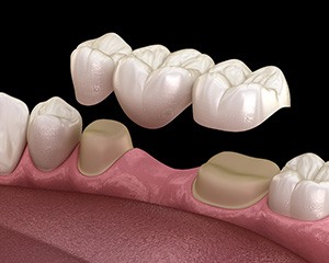 A 3D illustration of a traditional dental bridge