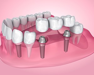 A 3D illustration of an implant bridge