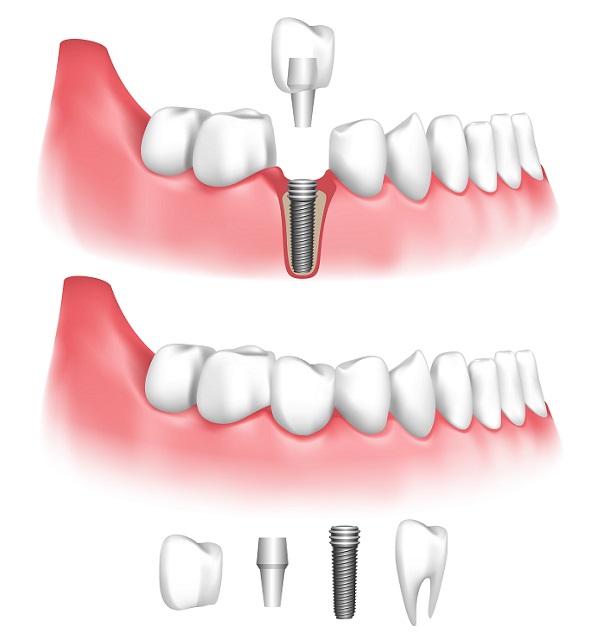 Are Dental Implants from My Dentist in Milwaukee Right for Me? - Barry ...